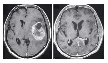 Προεγχειρητική (αριστερά) και μετεγχειρητική (δεξιά) μαγνητική τομογραφία εγκεφάλου σε ασθενή με πολύμορφο γλοιοβλάστωμα