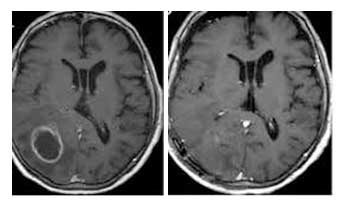 Προεγχειρητική (αριστερά) και μετεγχειρητική (δεξιά) μαγνητική τομογραφία εγκεφάλου σε ασθενή με εγκεφαλική μετάσταση