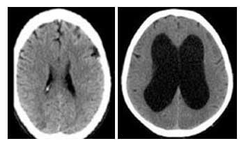 Αξονική τομογραφία εγκεφάλου που απεικονίζει φυσιολογικό κοιλιακό σύστημα (αριστερή εικόνα) σε σύγκριση με διατεταμένο κοιλιακό σύστημα σε υδροκέφαλο (δεξιά εικόνα)