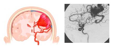 Σχηματική απεικόνιση (αριστερά) και απεικόνιση με DSA (δεξιά) AVM εγκεφάλου