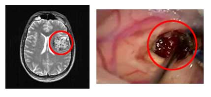 Απεικόνιση με μαγνητική τομογραφία (αριστερά) και διεγχειρητική εικόνα (δεξιά) σηραγγώδους αιμαγγειώματος εγκεφάλου