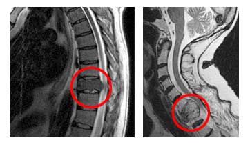 Απεικόνιση με μαγνητική τομογραφία μετάστασης στη
        θωρακική (αριστερά) και στην αυχενική (δεξιά)
        μοίρα της σπονδυλικής στήλης