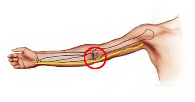 Σχηματική απεικόνιση ωλένιου νεύρου και θέσης παγίδευσής του στον αγκώνα