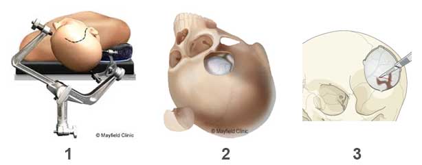 Στήριξη κεφαλής σε ειδικό πλαίσιο, Διάνοιξη κρανίου, Διάνοιξη μήνιγγας