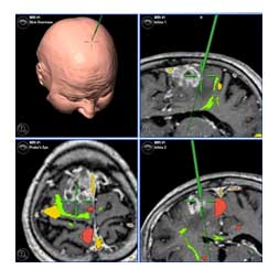 Σχεδιασμός στερεοτακτικής βιοψίας εγκεφάλου με σύστημα νευροπλοήγησης