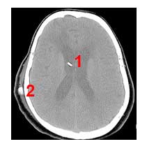Αξονική τομογραφία εγκεφάλου ασθενούς με καθετήρα στο κοιλιακό σύστημα και βαλβίδα