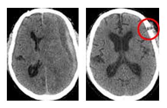 Προεγχειρητική (αριστερά) και μετεγχειρητική (δεξιά) αξονική τομογραφία εγκεφάλου σε ασθενή με χρόνιο υποσκληρίδιο αιμάτωμα.