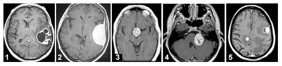 Απεικόνιση με μαγνητική τομογραφία διάφορων εγκεφαλικών όγκων (1. γλοιοβλάστωμα, 2. μηνιγγίωμα, 3. αδένωμα υπόφυσης, 4. ακουστικό νευρίνωμα, 5. μεταστάσεις)