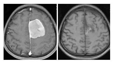 Προεγχειρητική (αριστερά) και μετεγχειρητική (δεξιά) μαγνητική τομογραφία εγκεφάλου σε ασθενή με μηνιγγίωμα