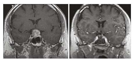 Προεγχειρητική (αριστερά) και μετεγχειρητική (δεξιά) μαγνητική τομογραφία εγκεφάλου σε ασθενή με αδένωμα υπόφυσης