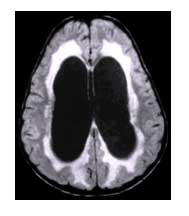Μαγνητική τομογραφία εγκεφάλου που απεικονίζει υδροκέφαλο (η λευκή άλως γύρω από τις κοιλίες του εγκεφάλου αντιστοιχεί σε περικοιλιακή διαβροχή)