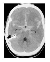 Απεικόνιση υπαραχνοειδούς αιμορραγίας με αξονική τομογραφία εγκεφάλου
