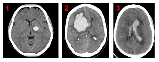 Απεικόνιση με αξονική τομογραφία εγκεφάλου μικρής ενδοεγκεφαλικής αιμορραγίας υπερτασικής αιτιολογίας εκτεταμένης ενδοεγκεφαλικής αιμορραγίας ενδοκοιλιακής αιμορραγίας