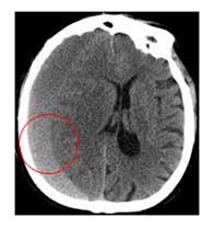 Απεικόνιση χρόνιου υποσκληρίδιου αιματώματος με αξονική τομογραφία εγκεφάλου