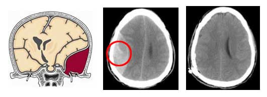 Σχηματική απεικόνιση (αριστερά) και αξονικές τομογραφίες εγκεφάλου ασθενούς με επισκληρίδιο αιμάτωμα (προ- και μετεγχειρητικά)