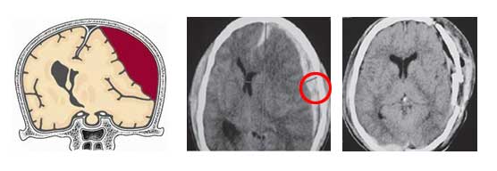Σχηματική απεικόνιση (αριστερά) και αξονικές τομογραφίες εγκεφάλου ασθενούς με οξύ υποσκληρίδιο αιμάτωμα (προ- και μετεγχειρητικά)