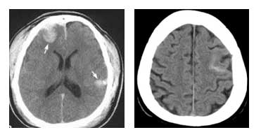 Απεικόνιση με αξονική τομογραφία εγκεφαλικών θλάσεων (αριστερά) και τραυματικής υπαραχνοειδούς αιμορραγίας (δεξιά)