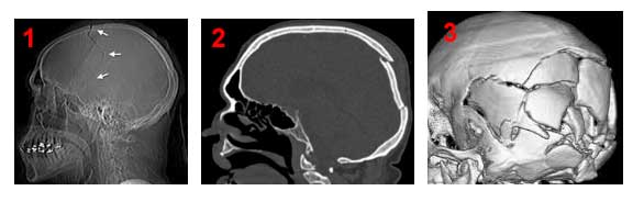 Απεικόνιση κατάγματος θόλου κρανίου με απλή ακτινογραφία, εμπιεστικού κατάγματος με αξονική τομογραφία και συντριπτικού κατάγματος κρανίου με αξονική τομογραφία σε 3D ανασύνθεση