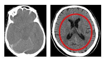 Αξονική τομογραφία εγκεφάλου με εκτεταμένο
        εγκεφαλικό οίδημα (αριστερά) σε σύγκριση με
        φυσιολογική εικόνα (δεξιά).
        Παρατηρείται πλήρης εξάλειψη του κοιλιακού
        συστήματος (δακτύλιος) και 