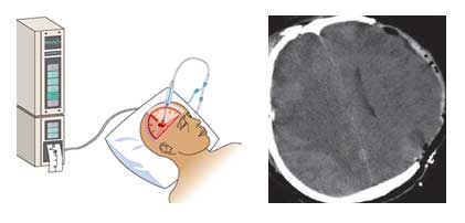 Σχηματική απεικόνιση καθετήρα μέτρησης ενδοκράνιας πίεσης (αριστερά)
        και αξονική τομογραφία ασθενούς με οστικό έλλειμμα κρανίου λόγω
        αποσυμπιεστικής κρανιεκτομίας για την αντιμετώπιση εγκεφαλικού οιδήματος (δεξιά)