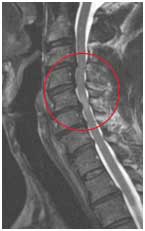 Πολυεπίπεδη στένωση αυχενικής μοίρας σπονδυλικού σωλήνα ΑΜΣΣ- Η αυχενική μυελοπάθεια απεικονίζεται στη μαγνητική τομογραφία ως  άσπρη κηλίδα
